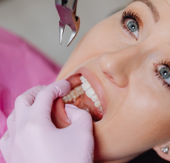 Tooth Extractions - Pearl Dentistry of Butler