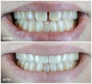 Dental Bonding - Pearl Dentistry of Butler