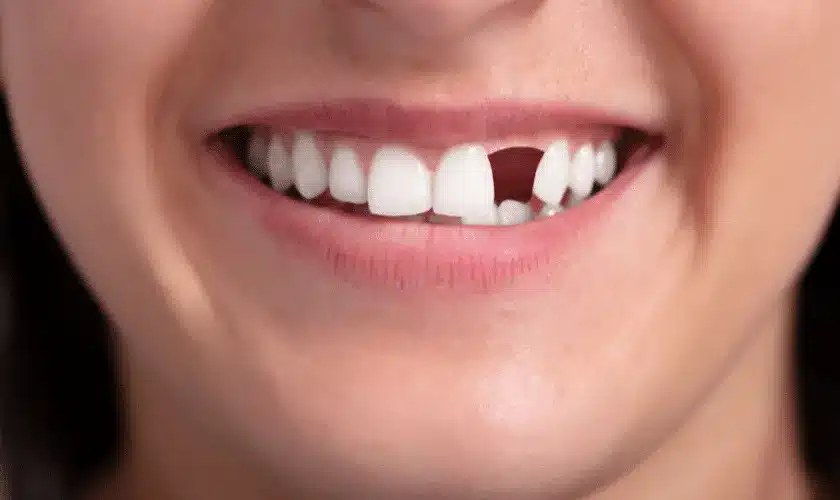 Easily replace missing teeth using dental implants