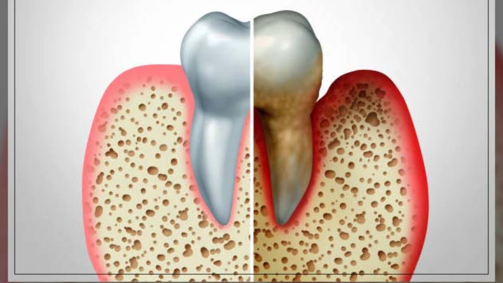 The Link Between Osteoporosis and Oral Health