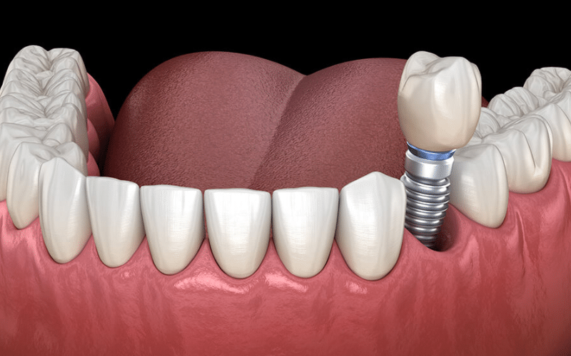 What to do if a dental implant falls out